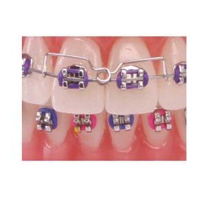 AMERICAN ORTHODONTICS / Torquing Spring - Synergie Medicale Maroc